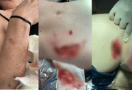 Mulher é mordida por capivara e tem partes do corpo arrancadas em SC