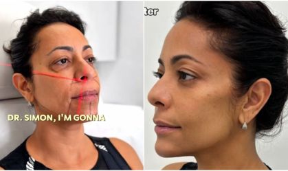 Samantha Schmütz transforma rosto com médico das Kardashians; veja