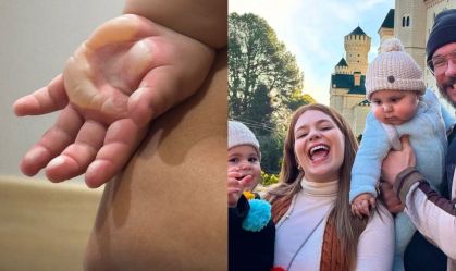 Queimaduras de 2º grau em bebês: o que fazer e como tratar?