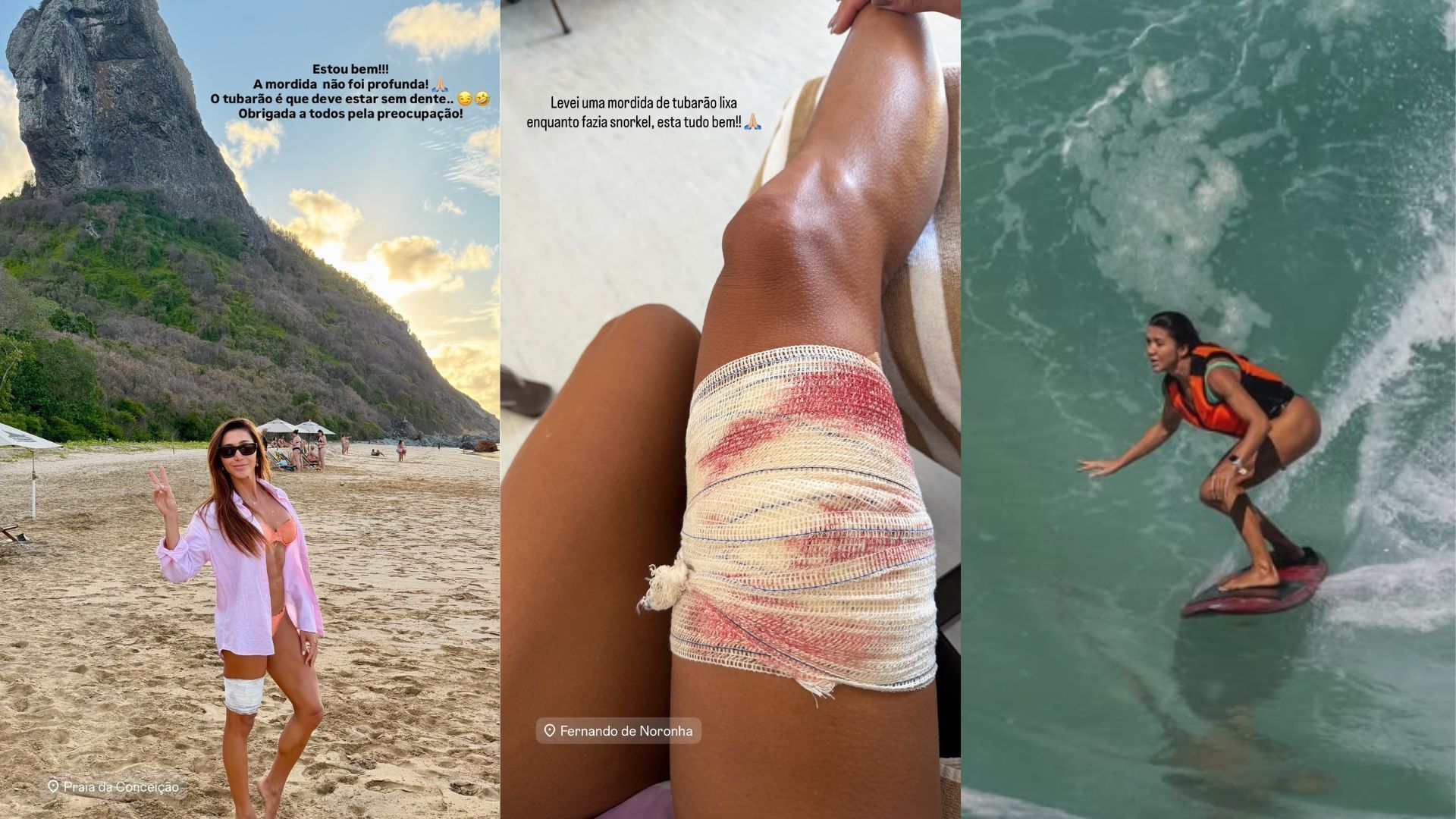 TURISTA-MORDIDA-TUBARÃO-NORONHA
