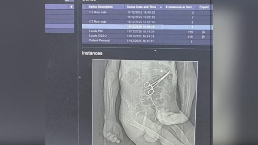 Pinça teria sido esqeucida após primeria cirurgia • Reprodução