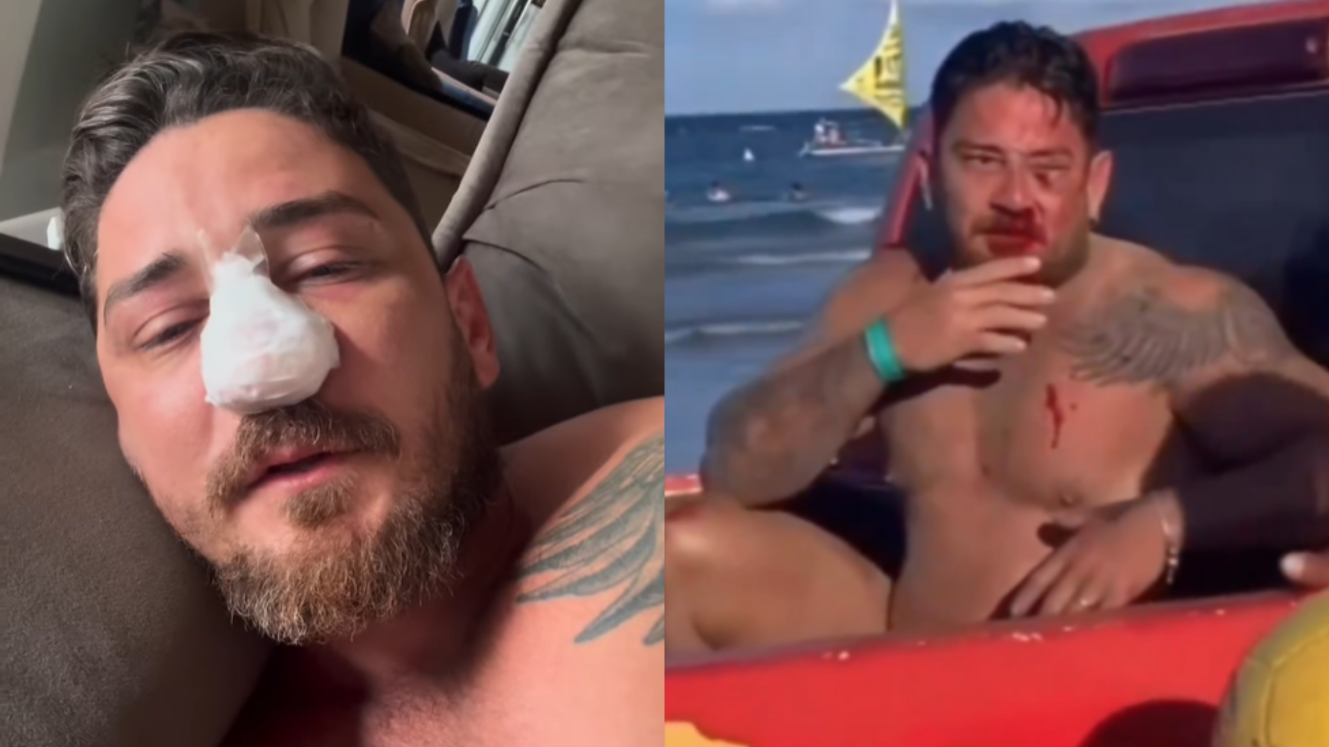 Jhonny contou nas redes sociais que havia perdido a sensibilidade de metade do rosto por conta do rompimento de um nervo