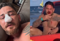 Turista agredido em Porto de Galinhas faz cirurgia após sofrer 4 fraturas