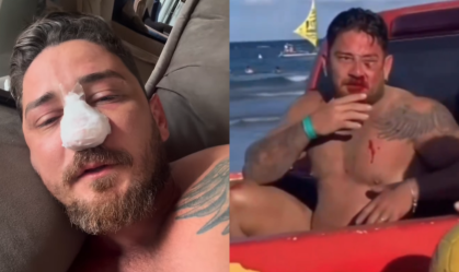 Jhonny contou nas redes sociais que havia perdido a sensibilidade de metade do rosto por conta do rompimento de um nervo