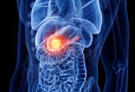 Estudo revela proteína ligada ao avanço do câncer de pâncreas pelos nervos