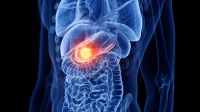 Estudo revela proteína ligada ao avanço do câncer de pâncreas pelos nervos