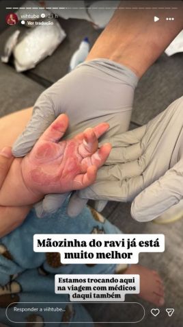 Viih Tube mostra mão de Ravi 12 dias após acidente • Instagram/Viih Tube