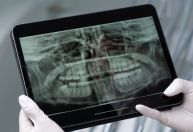 Saliva artificial ajuda a proteger dentes de pacientes com câncer de cabeça