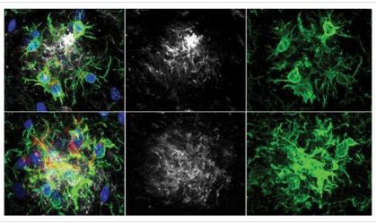 Pesquisadores descobrem maneira de retardar perda de memória no Alzheimer