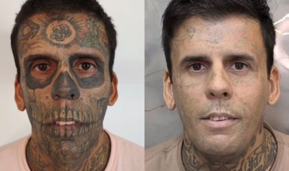 "Mais tatuado do Brasil" passa por nova remoção e fala em vida missionária