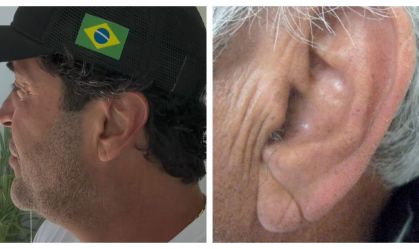 Sinal de Frank pode indicar risco de infarto? Dr. Kalil explica