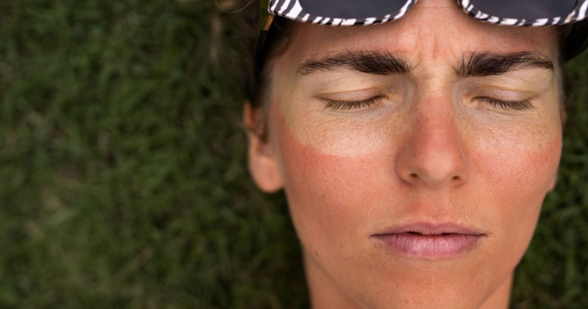 Como minimizar os danos da exposição solar acumulada?