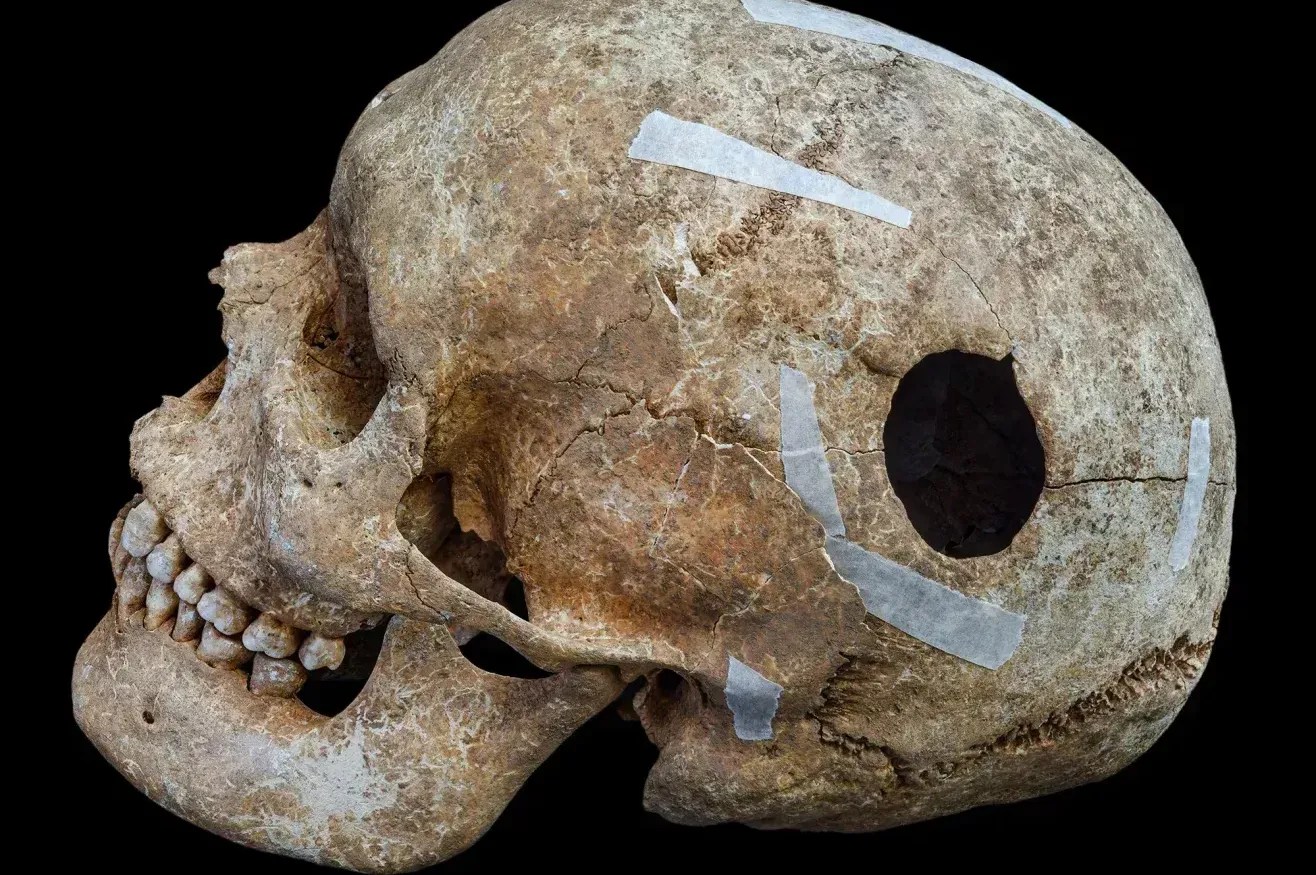 individual-with-trepanned-skull-2
