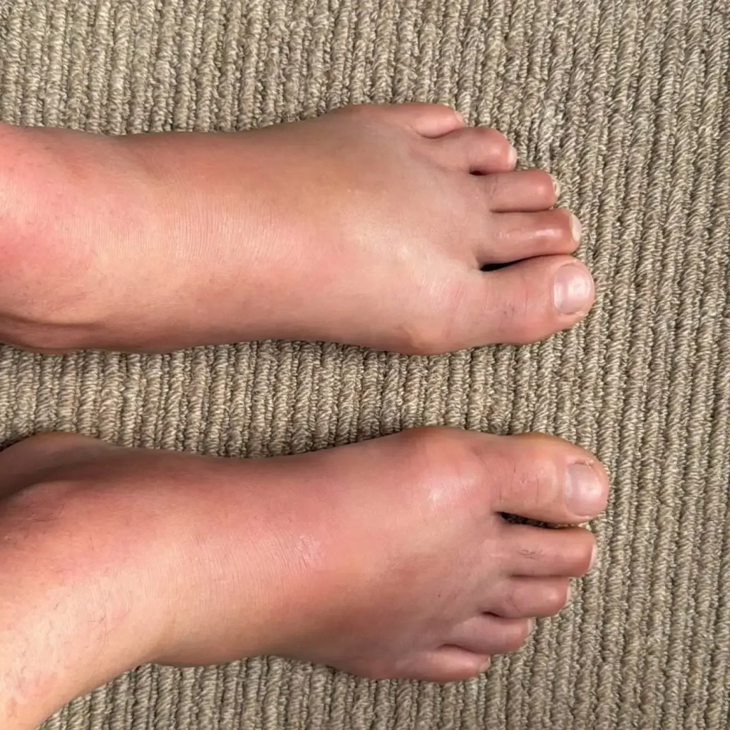 Brasileiro Diego Lopes, fraturou os dois pés em combate do UFC