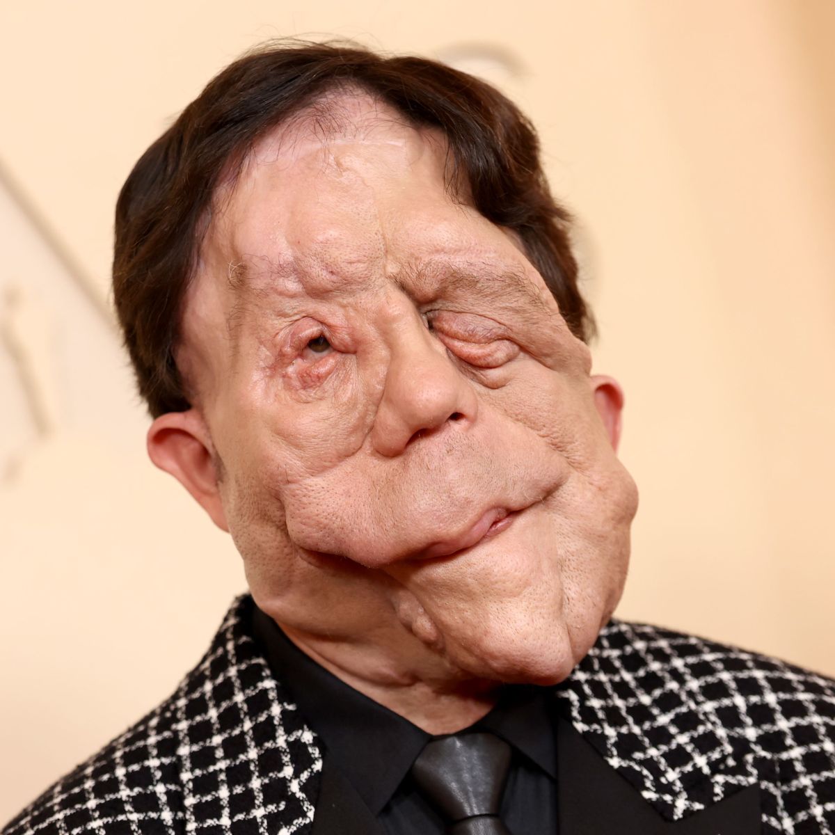 O que é neurofibromatose, condição que afeta o ator Adam Pearson | CNN  Brasil