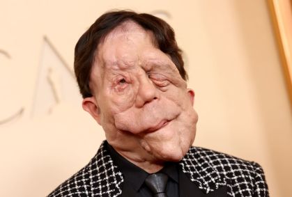 O que é neurofibromatose, condição que afeta o ator Adam Pearson
