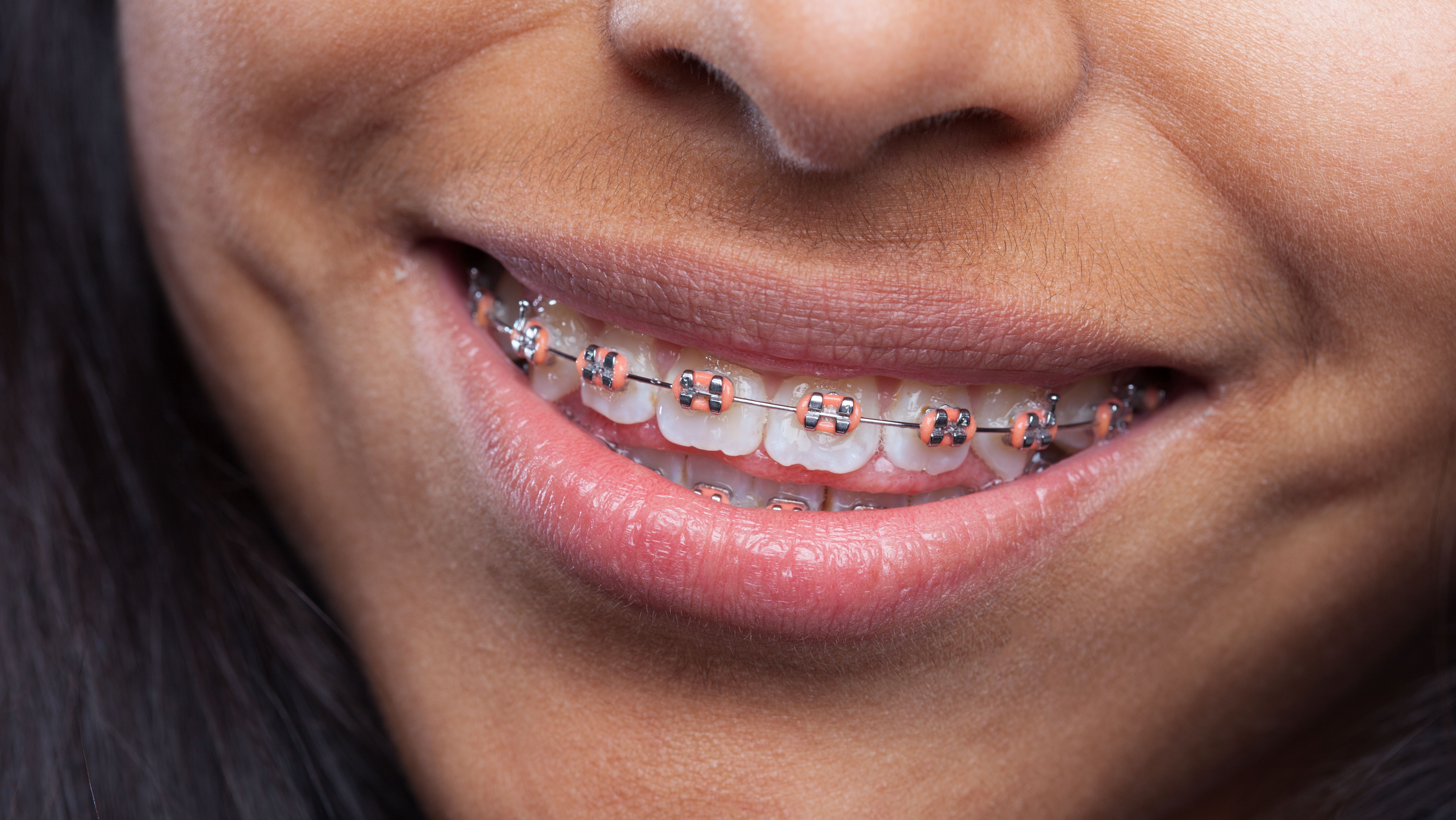 Dentes podem entortar mesmo após o uso de aparelho ortodôntico