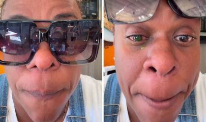 Cacau Protásio relata perda de visão após uso de pomada de cabelo