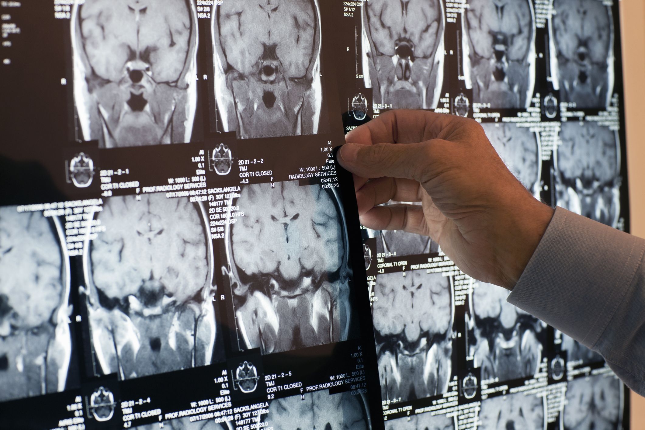 Doctor's hand on head x-ray