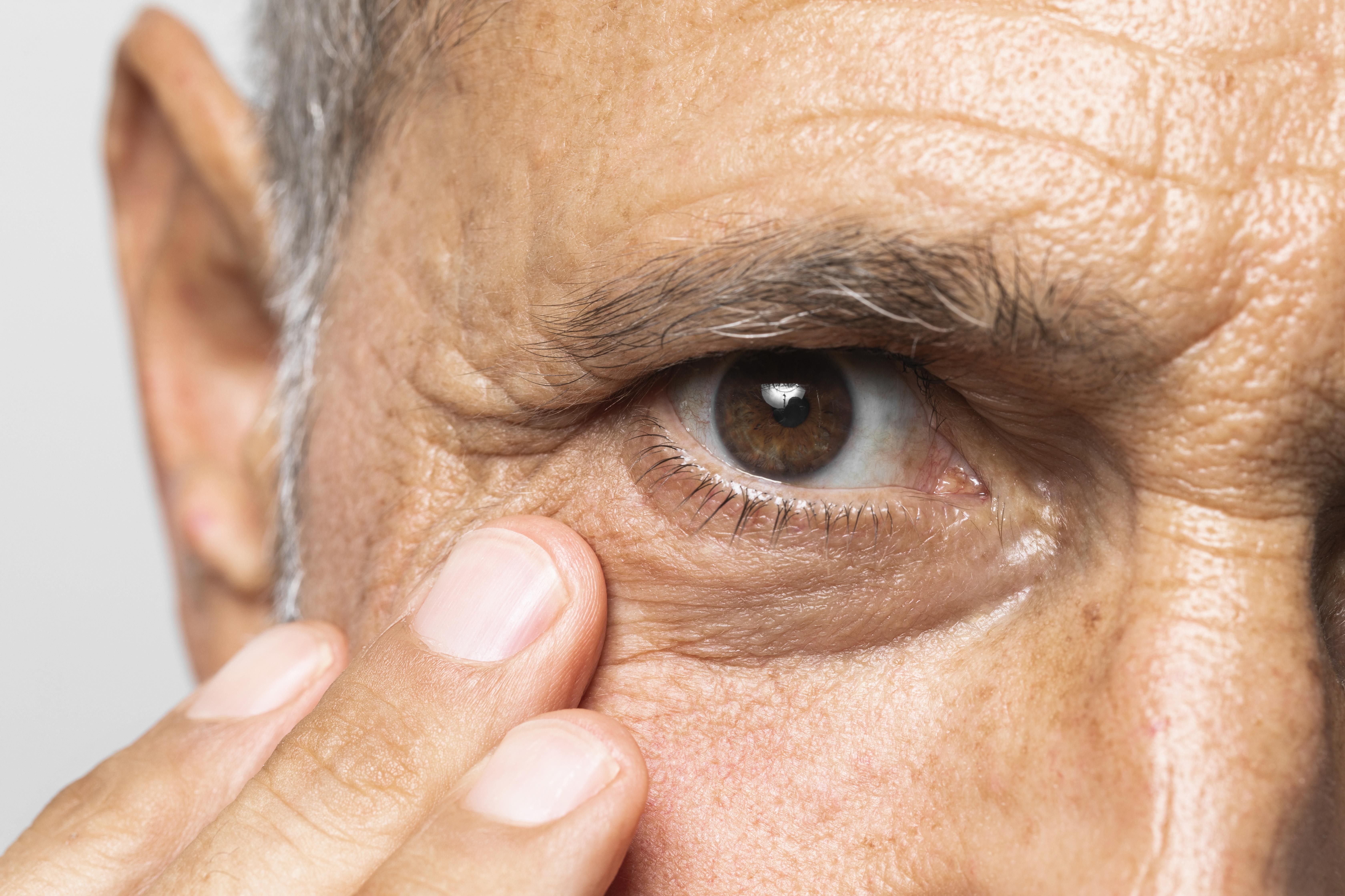 glaucoma