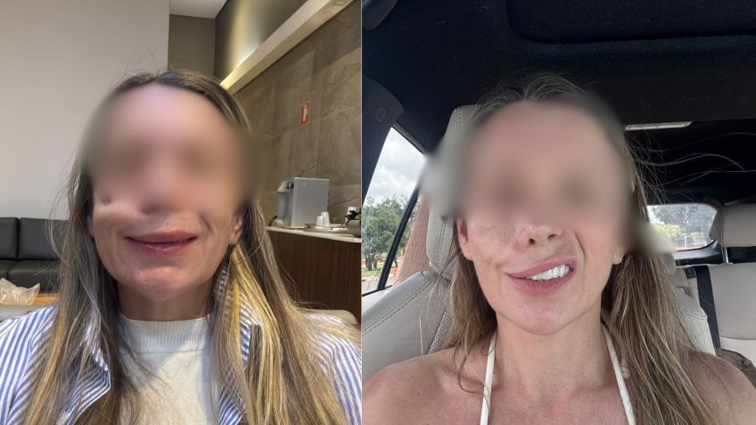 Foto enviada pela paciente após falhas no procedimento realizado em seu rosto• Reprodução