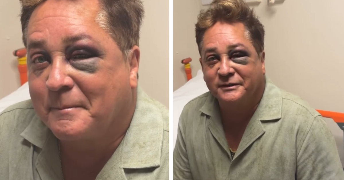 Leonardo aparece com olho roxo após sofrer acidente em pescaria; veja