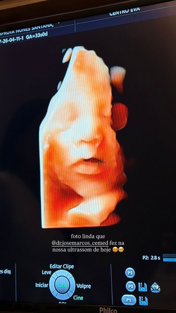 Lore Improta mostra novo ultrassom