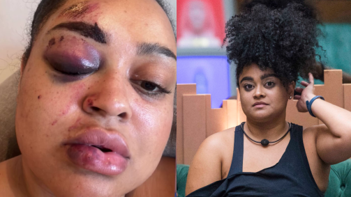 Rizia Cerqueira sofreu acidente enquanto dirigia uma moto elétrica
