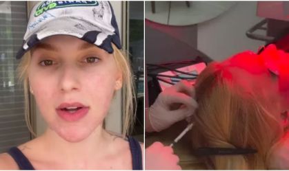 virginia-alopecia