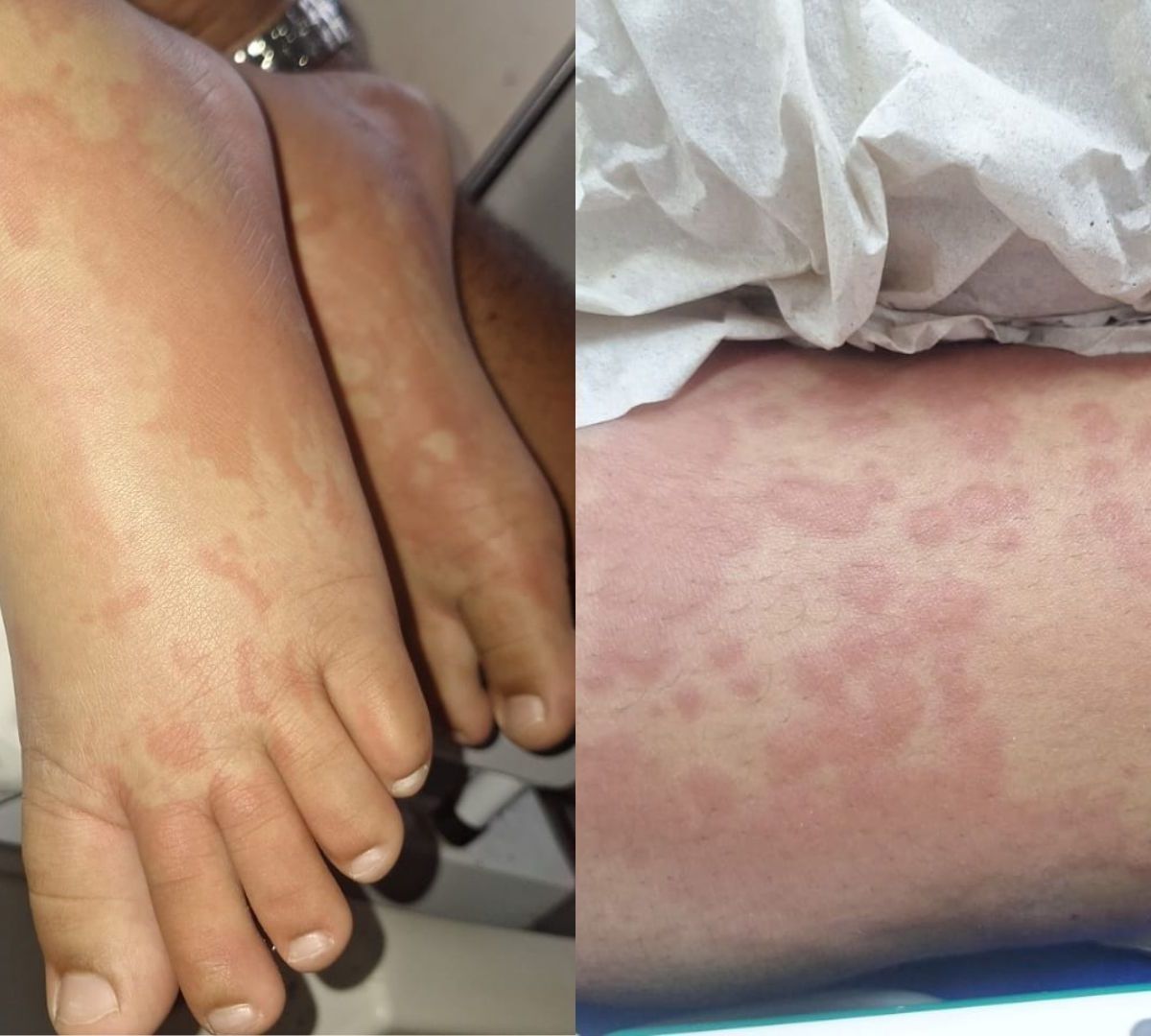 Suspeita de contaminação por detergente: saiba quadro de criança internada