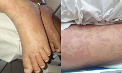 CRIANÇA INTERNADA APÓS USO DE DETERGENTE