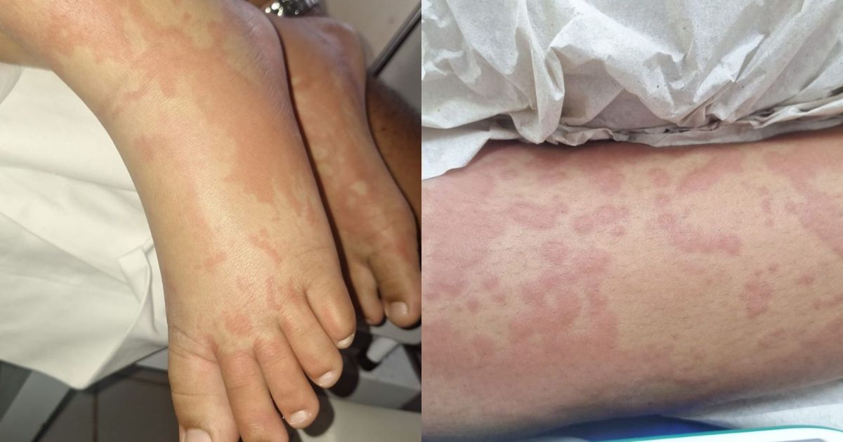 Criança internada no RN teve manchas após uso de detergente, diz tio