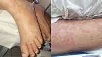Criança internada no RN teve manchas após uso de detergente, diz tio