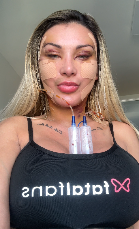Andressa Urach fala de nova cirurgia no rosto • Arquivo Pessoal