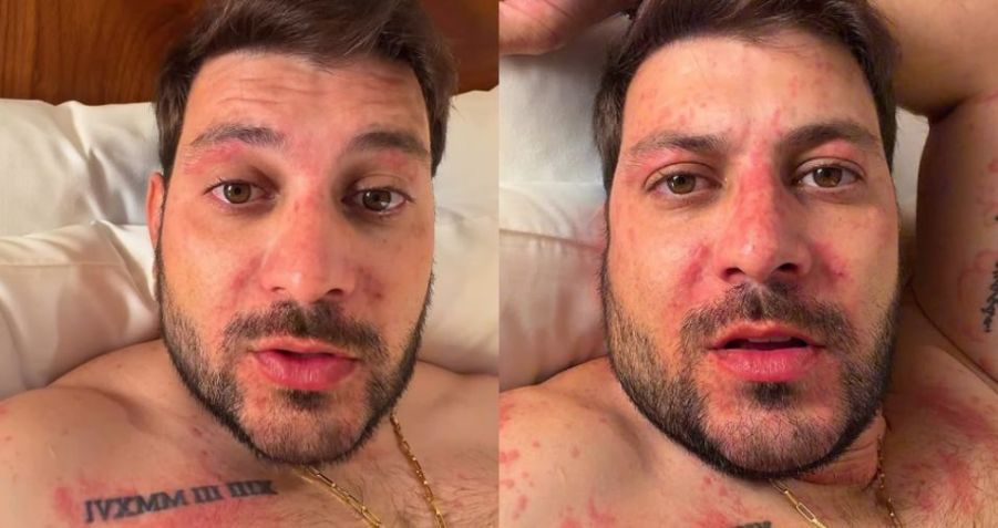 Caio Afiune relatou quadro de reação alérgica grave • Instagram/Caio Afiune