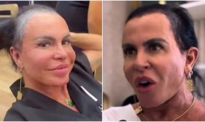 gretchen-alopecia