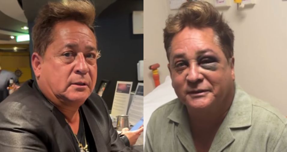 Leonardo explica acidente em pescaria que causou fratura no rosto
