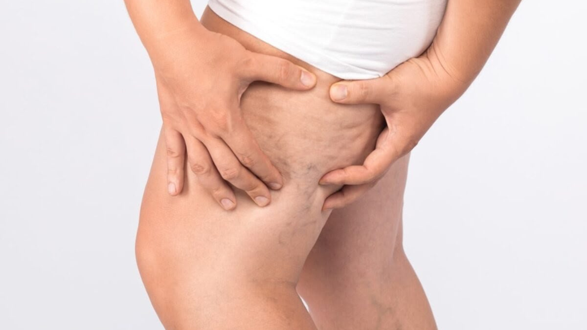 Lipedema também pode atingir homens