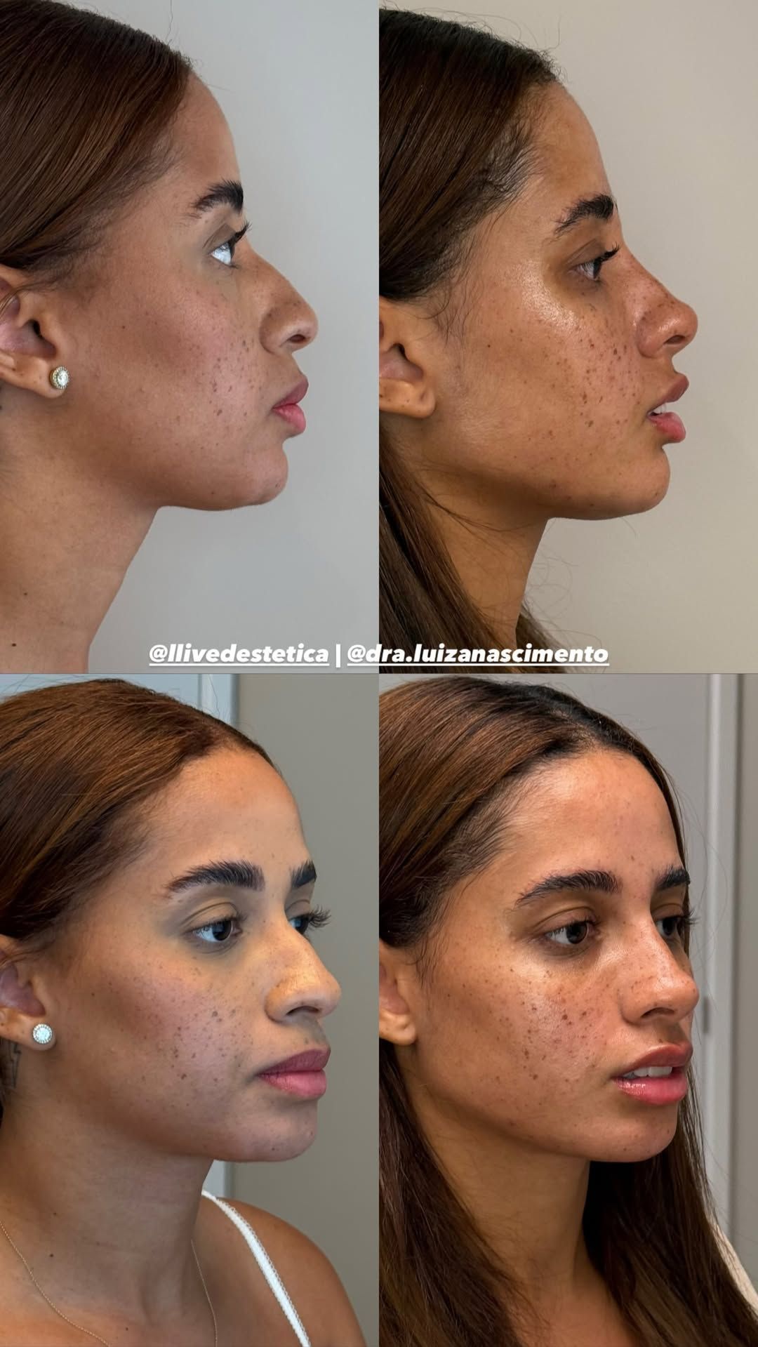 Lomma mostrou antes e depois de procedimentos • Instagram/@lomma