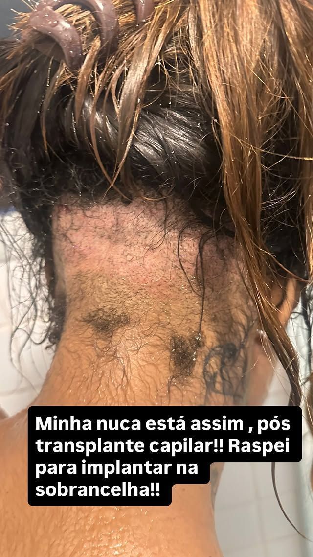 Carol Lekker raspou a nuca para transplantar na sobrancelha • Reprodução/Instagram