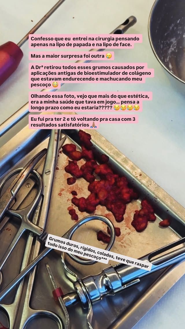 Ex-BBB mostra grumos encontrados na região de seu pescoço em lipo papada • Instagram/Paula Freitas