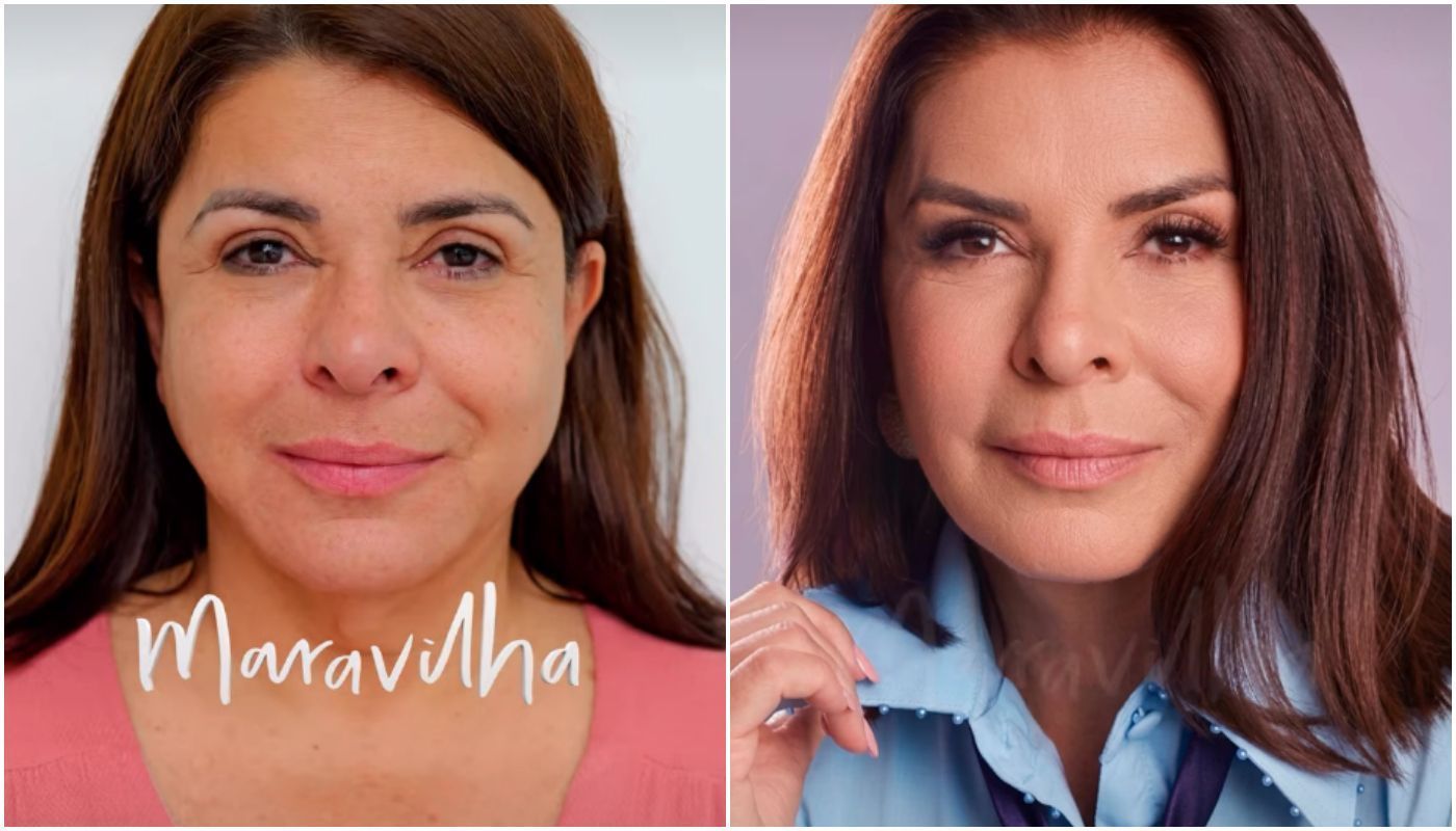 Antes e depois de Mara Maravilha • Instagram / Dr. Claudio Dias