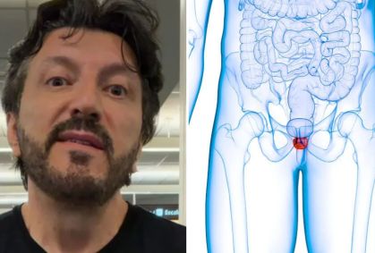 Influencer Lito Sousa com câncer de próstata: entenda doença e tratamento