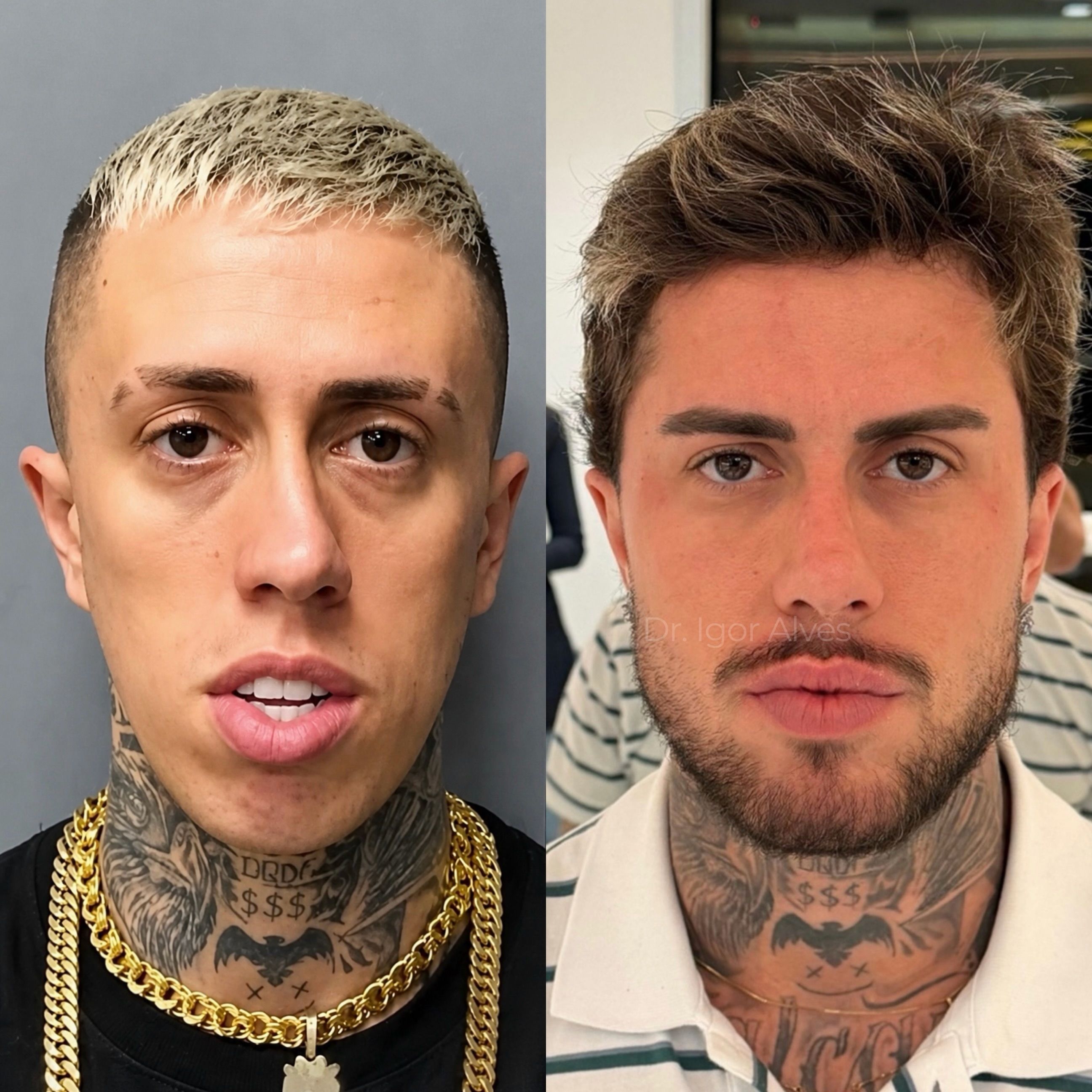 MC Daniel posta antes e depois de harmonização facial • Instagram/MC Daniel