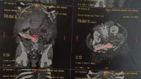Mulher perde parte do intestino após instrumento esquecido em cirurgia