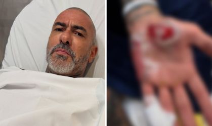 Fogaça detalha acidente de moto após gravações de do MasterChef