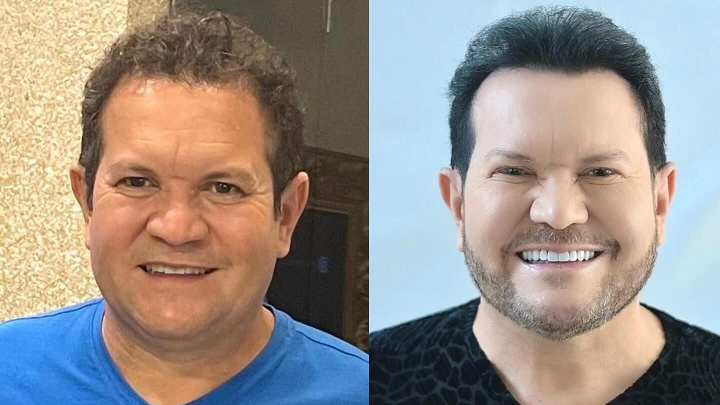 Ximbinha passou por harmonização facial em 2024 • Instagram/Ximbinha