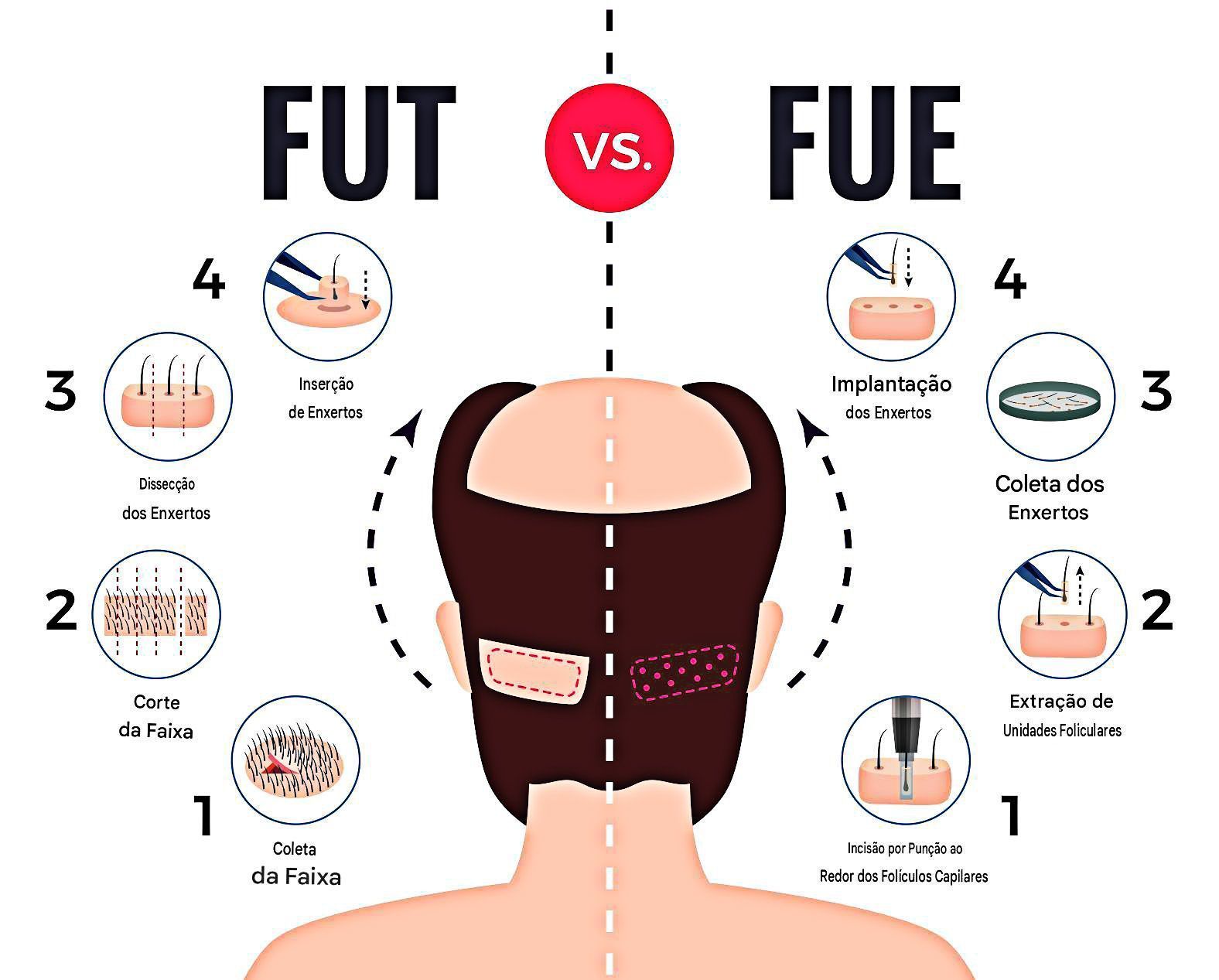 infográfico-com-diferença-entre-os-métodos-FUT-e-FUE