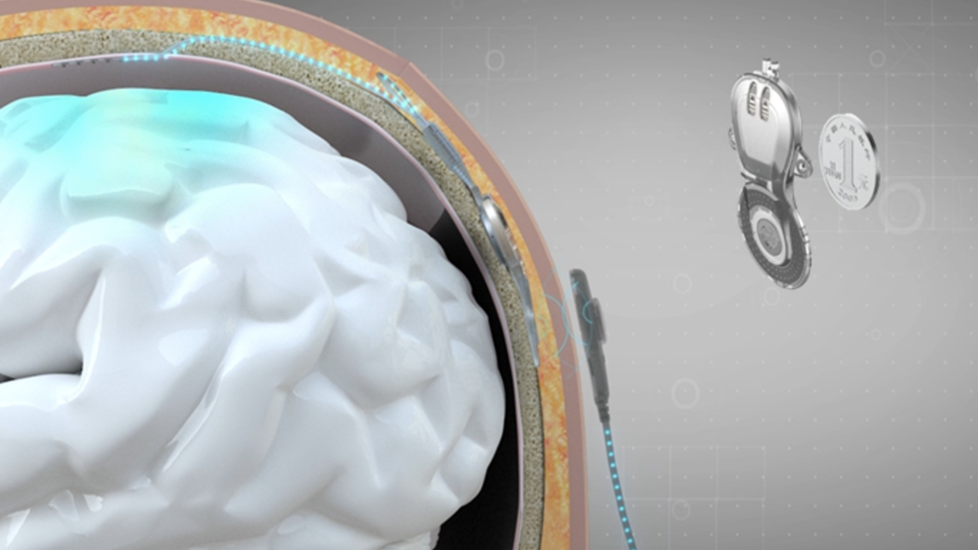A matriz de eletrodos epidurais é implantada no crânio acima da área funcional localizada, coletando potenciais de campo locais, o que mantém os tecidos neurais intactos. • Universidade de Tsinghua