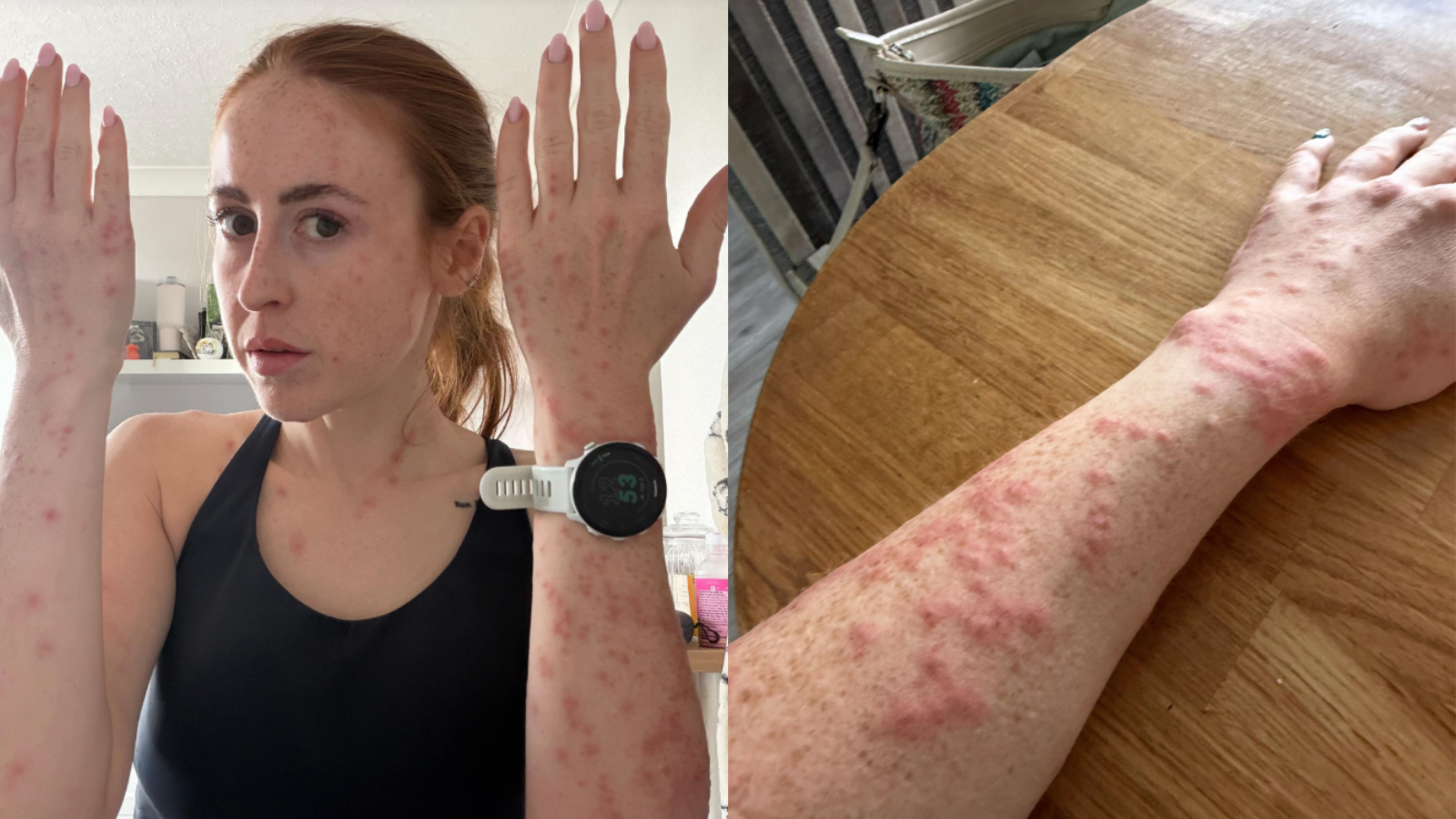 A influencer de viagem mostrou como picadas de percevejo deixaram seu corpo